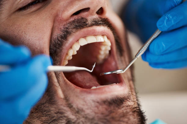 Best Chipped Tooth Repair Near Me  in Miami, OK